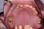 At your two month provisional picture, did you fabricate your provisional with equal incisal edges and the contact closed? My additional concern is it has opened in response to the functional forces.