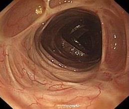 Case 2 Strategies for detecting colon cancer in patients with inflammatory bowel disease o 61 year old male o Ulcerative pancolitis for 22 years was well on 5-ASA o Flare 5 years ago treated with