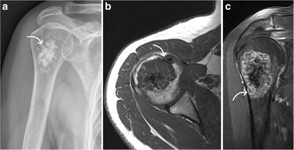 Although filling out the complete proximal humerus, sufficient stability was achieved without additional osteosynthesis as no postoperative fractures were found later on for all equally treated cases.