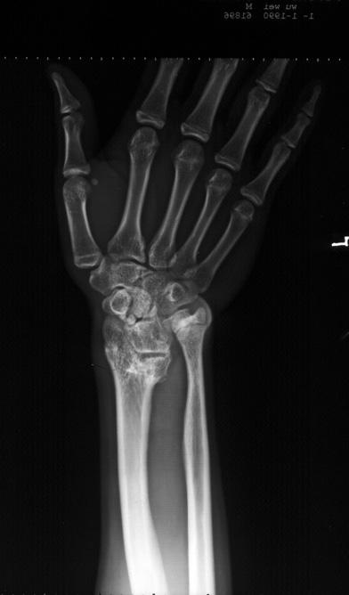 128 Bone Grafting Fig. 3. Male, 54 years old. Distal radius fracture and plaster splint was used after injury. No bone grafting and fixator were giving.