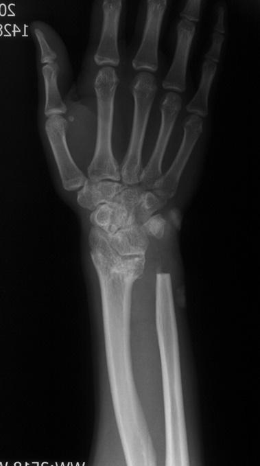Discussion The routine clinical treatment of distal radius fractures is closed reduction and/or external fixation.