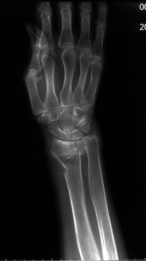 Treatment of Distal Radius Bone Defects with Injectable Calcium Sulphate Cement 131 5.