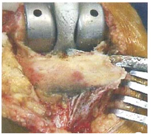 Total knee arthroplasty osteotomy soft tissue release 459 distinctly better than the preoperative indicies (p<0.05) and the differences were statistically significant.
