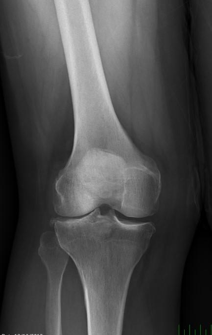 Coronal Alignment Based on short standing AP radiographs of the knee Mechanical axis is