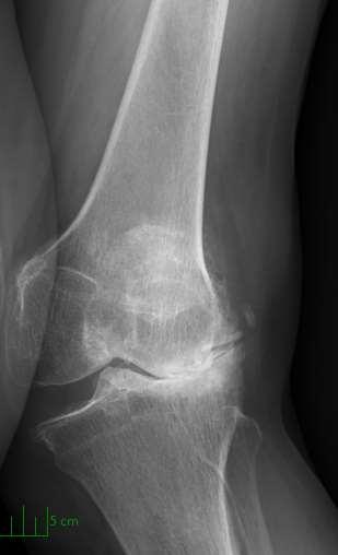 Post op radiographs were obtained at the 2 week, 6 week, 3 month, and annual visits The
