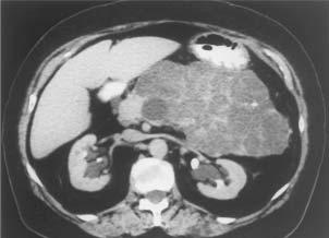 Can be diagnosed by CT in 30% of cases; diagnostic criteria include: Spongy mass with a central sunburst
