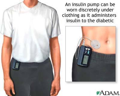 by an autoimmune destruction of insulin producing cells Type 2 (adult onset): caused by