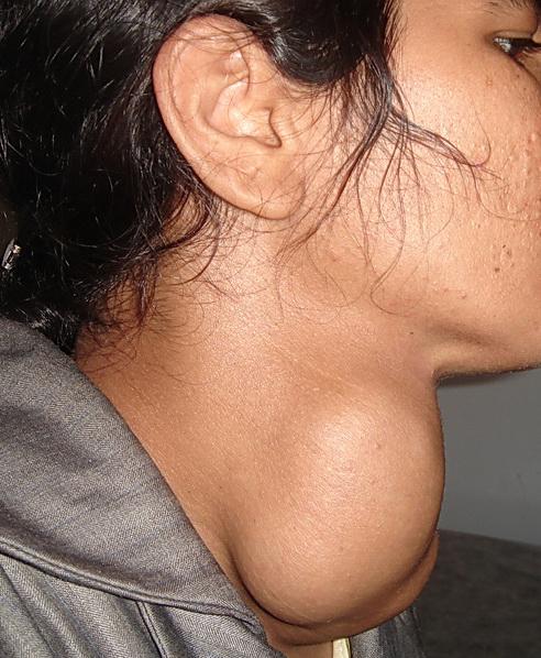 B. The Thyroid Gland 3.