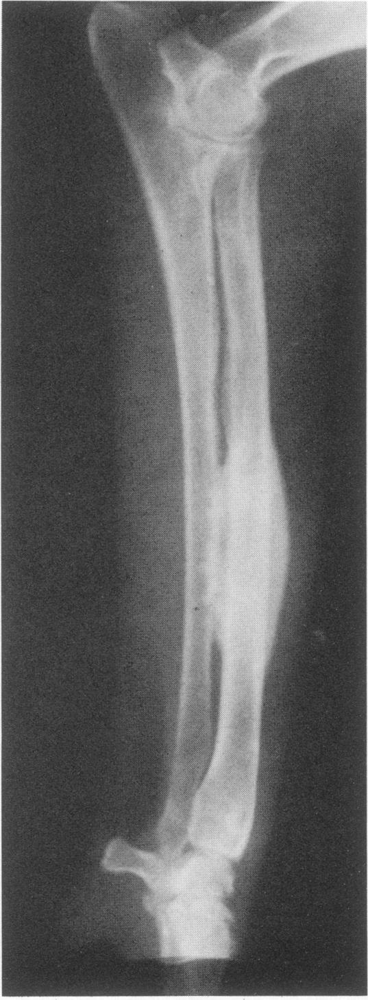 The distal metaphysis of the femur has periosteal proliferation and increased medullary density.
