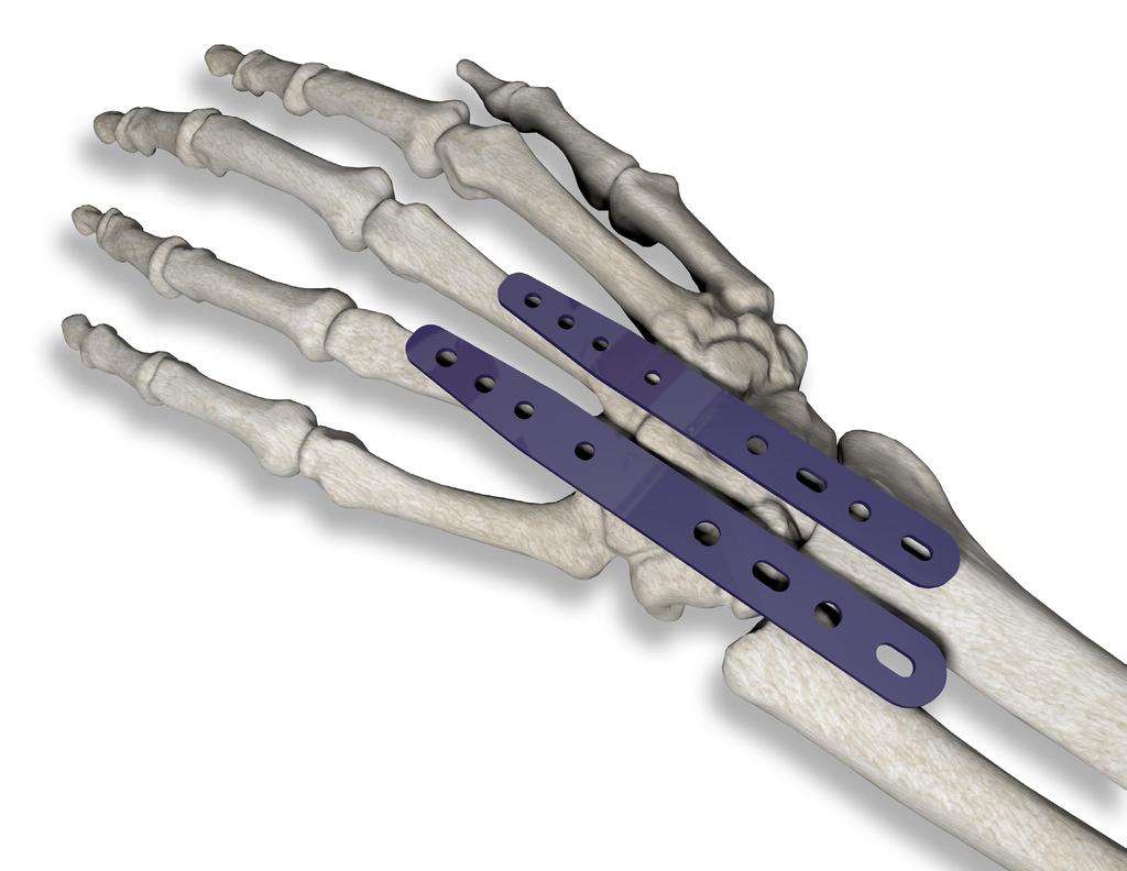 SURGICAL TECHNIQUE SELECT & CONTOUR PLATE The wrist fusion plate bending templates can aid in determining the appropriate length of implant to be used, and contour required for the final implant, by