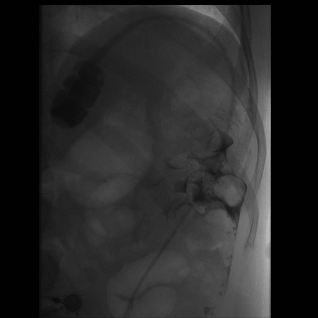 Fig. 9: Fluoroscopic guided low osmolar contrast injection of a laparoscopic adjustable gastric band in a