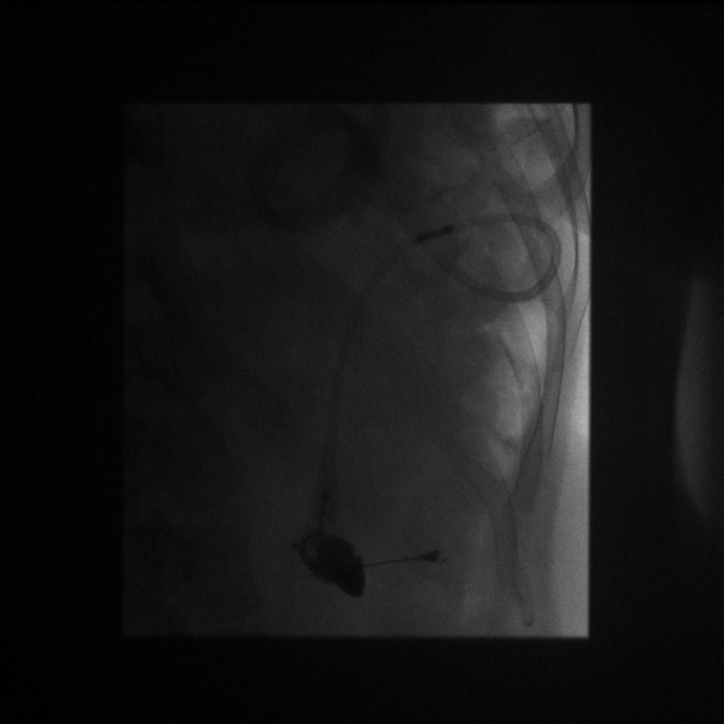 Fig. 10: Fluoroscopic-guided low osmolar contrast injection of a laparoscopic adjustable gastric band in a 41 year-old female