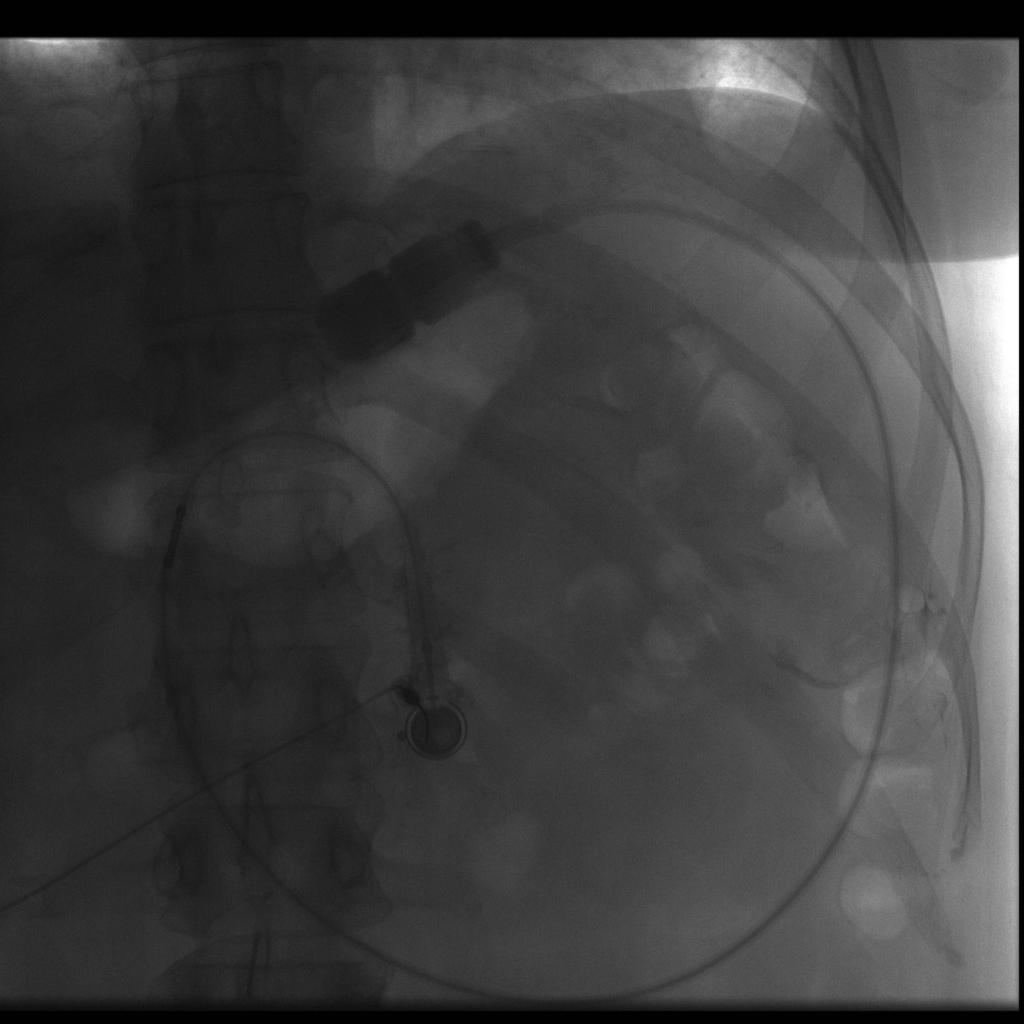 Fig. 11: Fluoroscopic-guided low osmolar contrast injection of a laparoscopic adjustable gastric band in a 45 year-old female