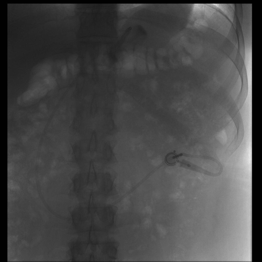 Fig. 12: Fluoroscopic image of a laparoscopic adjustable gastric band in a 33 yearold female patient