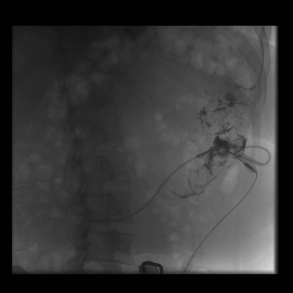 Fig. 13: Fluoroscopic-guided low osmolar contrast injection of a laparoscopic adjustable gastric band in a 33 year-old