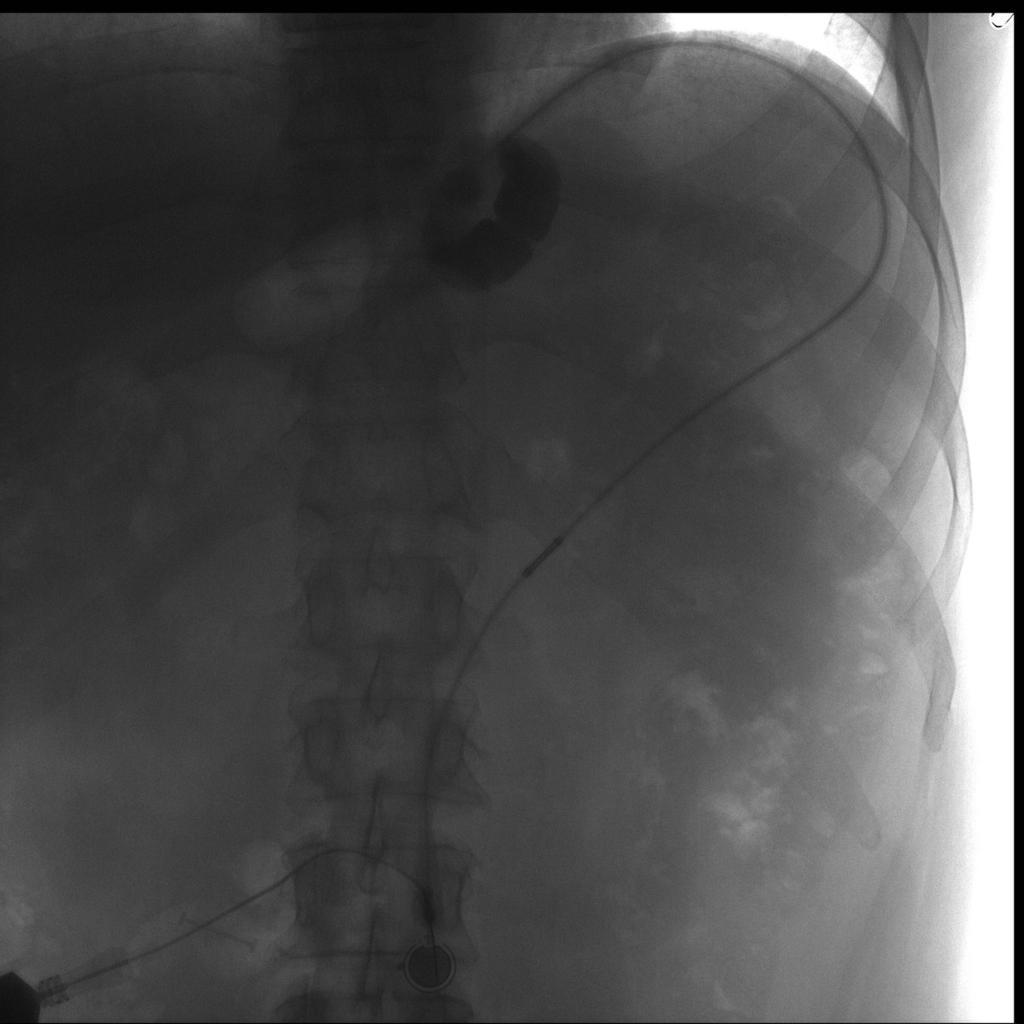 Fig. 2: Fluoroscopic-guided low osmolar contrast injection of a laparoscopic adjustable gastric band in a 29