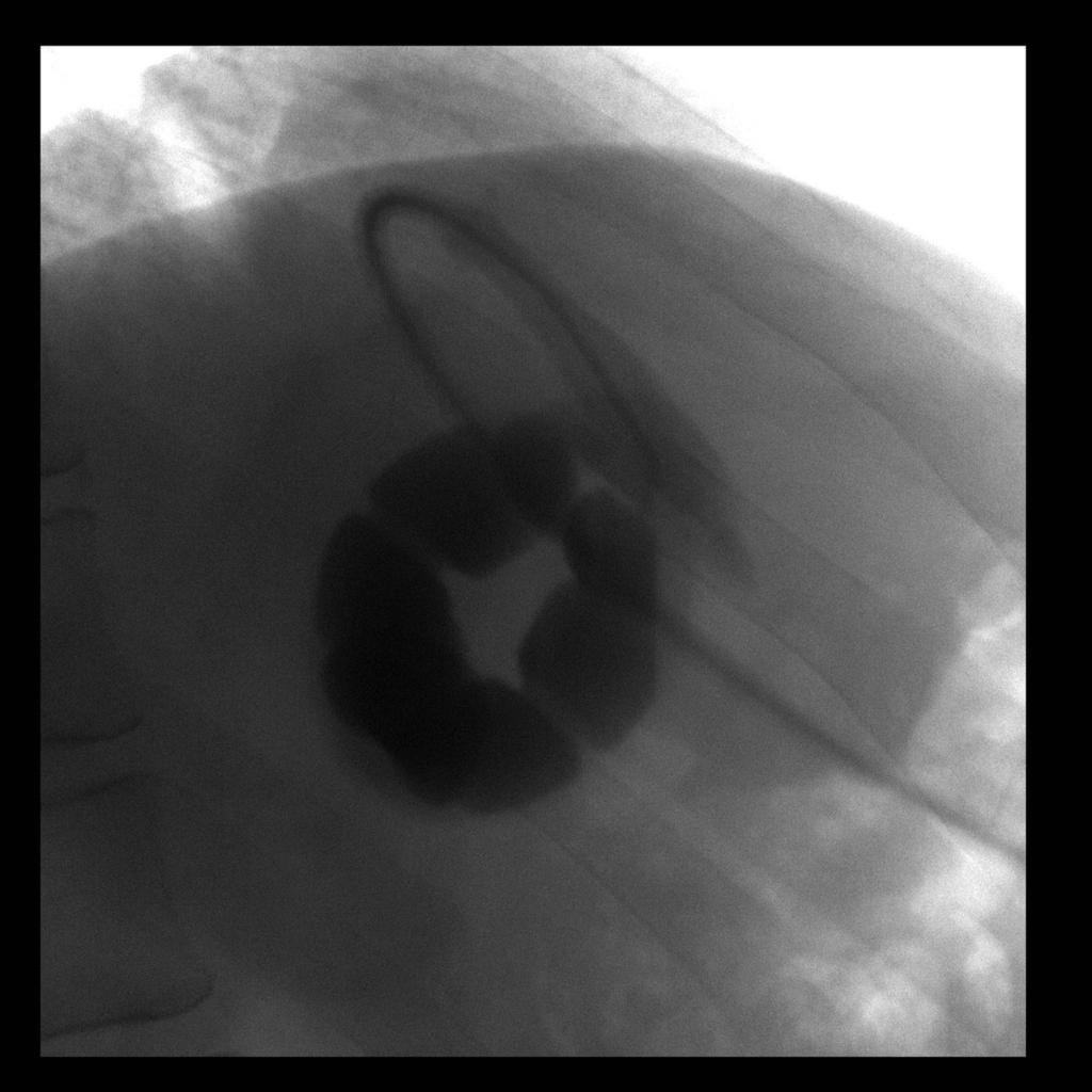 Fig. 3: Magnified fluoroscopic-guided low osmolar contrast injection of a laparoscopic adjustable