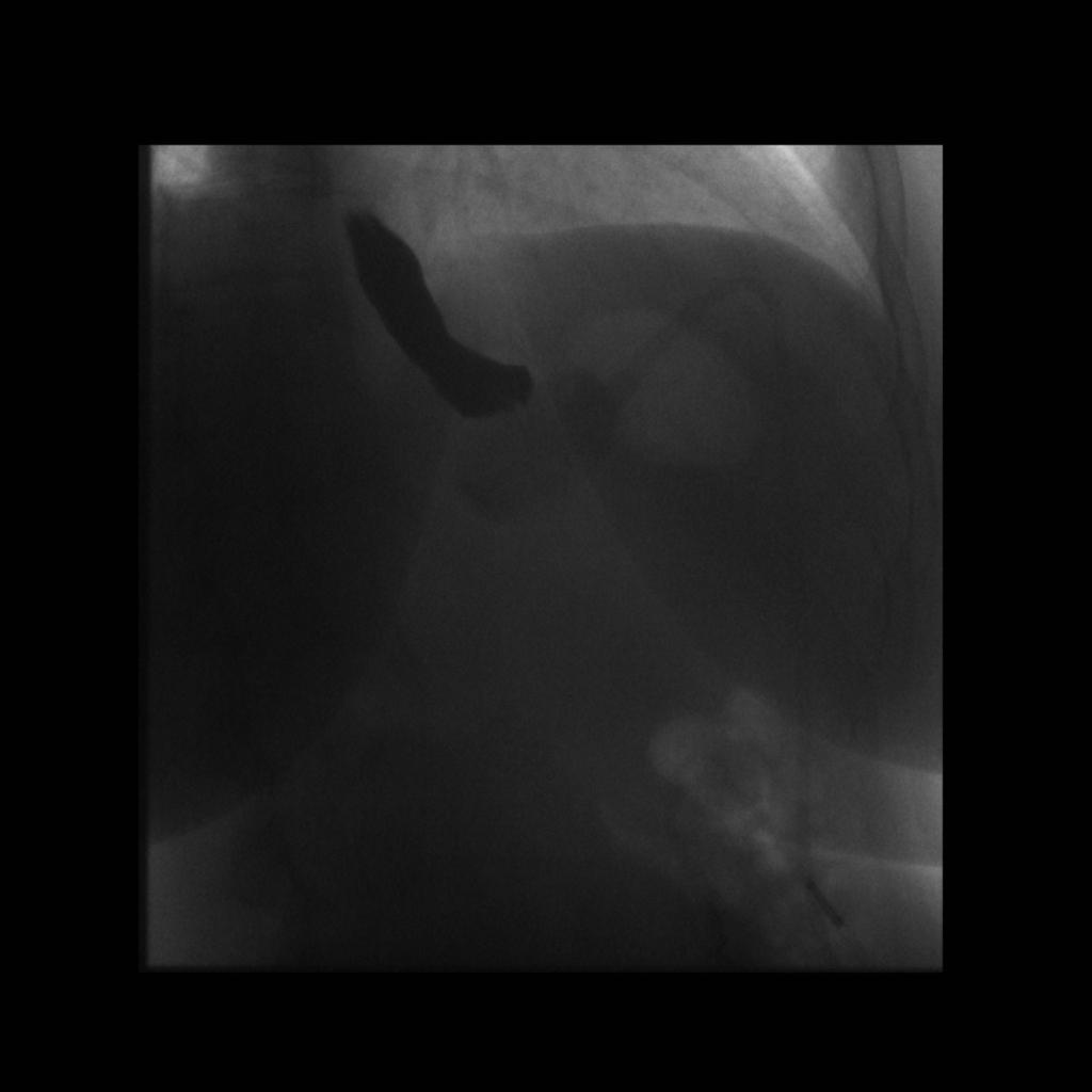 Fig. 4: Upper gastrointestinal tract barium study demonstrates complete occlusion of the