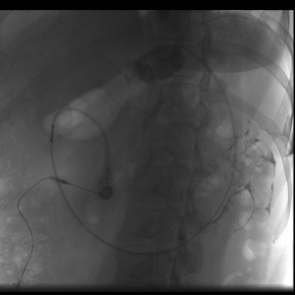 Fig. 5: Fluoroscopic-guided low osmolar contrast injection of a laparoscopic adjustable gastric band in a 39