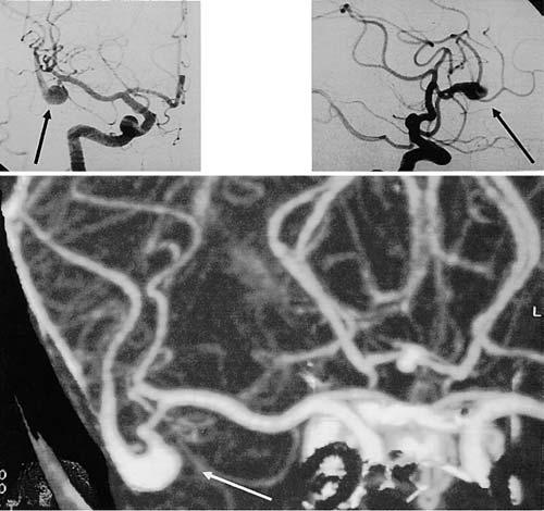 Anastomosis for distal middle cerebral artery aneurysms FIG. 1. Case 1.