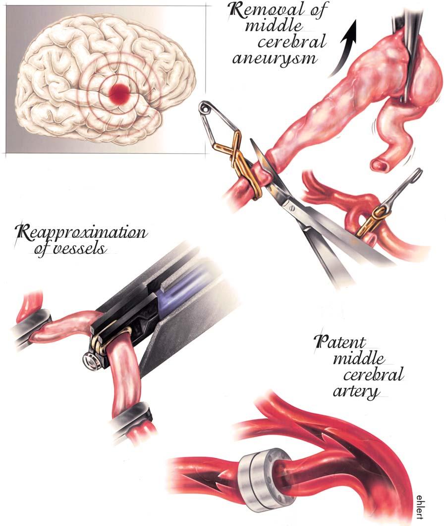 D. W. Newell, J. M. Schuster, and A. M. Avellino FIG. 3. Case 1. Artist s illustrations detailing the procedure used in this case. Upper Left: Site of the aneurysm.