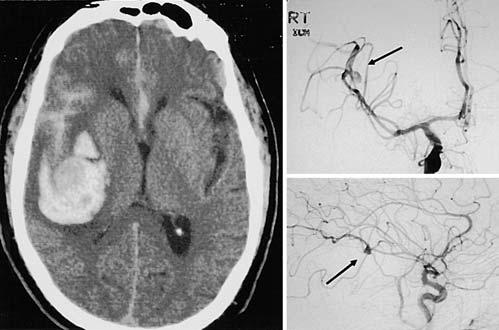A cerebral angiogram revealed a distally located ruptured aneurysm that originated from the largest angular branch of the MCA (Fig. 6).