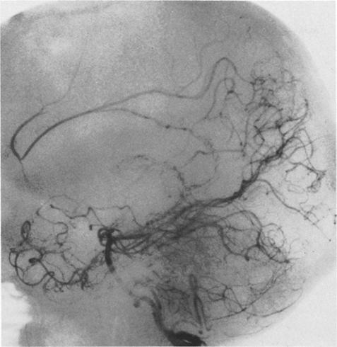 STA-ACA anastomosis with vein graft FIG. 3. Preoperative right external carotid angiogram. Both branches of the right superficial temporal artery were used for the anastomoses. Fro. 2.