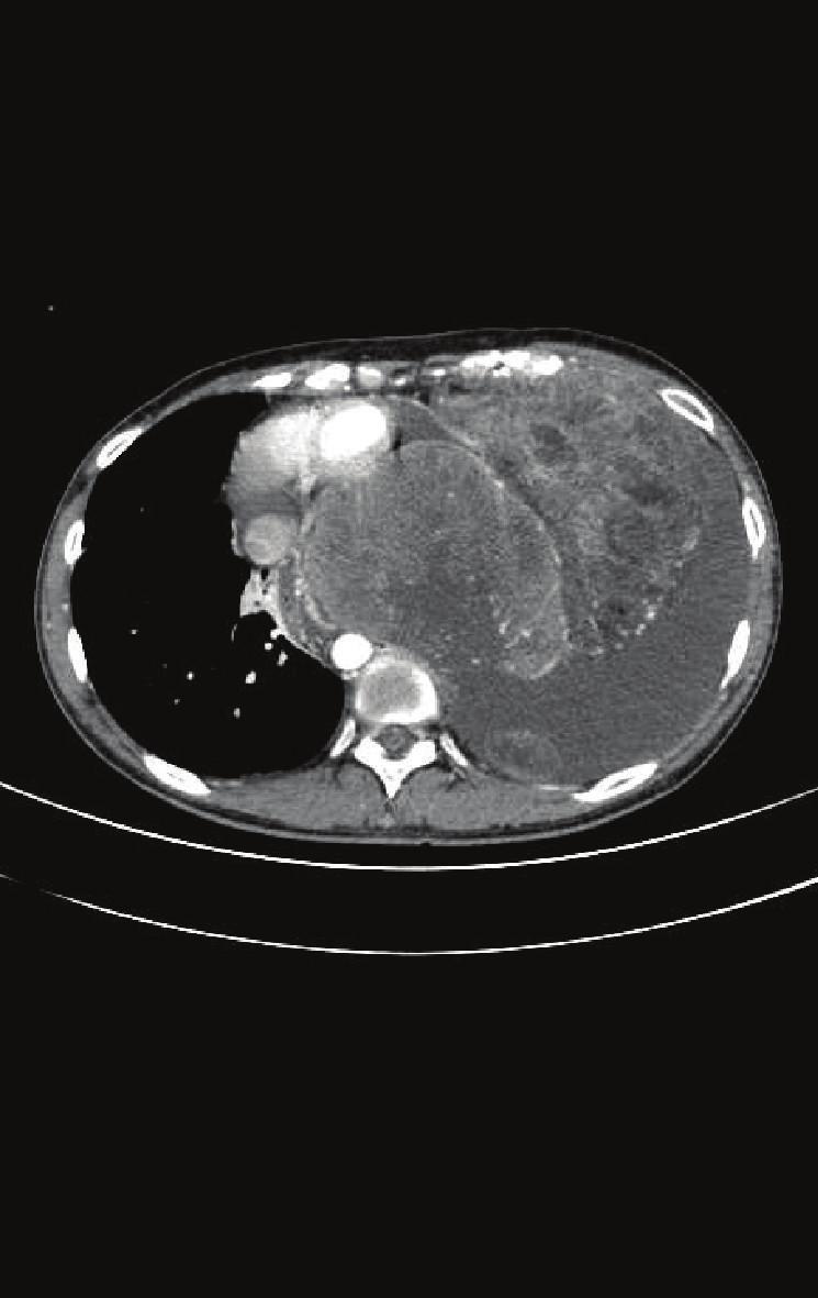 Case Reports in Oncological Medicine 3 Figure 4: Chest contrast-enhanced computed tomography (CT) before treatment showing a bulky mass in the left chest; pleural dissemination is seen.