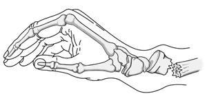 Colles Fracture Other ways the distal radius can break include: Intra-articular fracture extends into the wrist joint