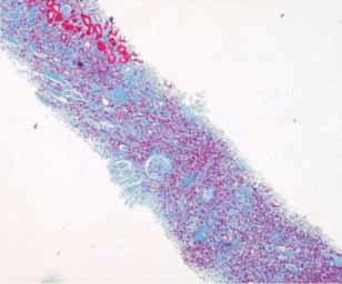 Tubulointerstitial nephritis associated with hepatitis C virus infection Considering the histological lesions present in the performed liver biopsy in 1997 and the presence of esophagic varices, a