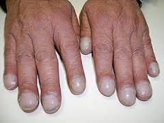 Clubbing of fingers is paraneoplastic,