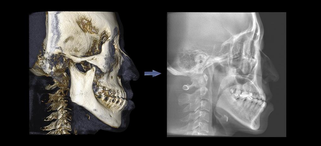 KIM ET AL 2145 left porions and the right orbitale, or mandibular menton deviation of more than 3 mm from the midsagittal plane, constructed by crista galli (the most superior point of crista galli