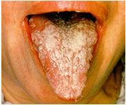 Coping with the Symptoms of Thrush Thrush can make the mouth very sensitive, this can make oral hygiene very difficult