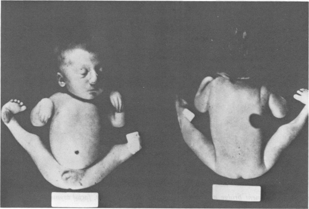 His birth weight was 2310 g (25th centile) (fig 3). At birth, multiple joint contractures and facial abnormalities were noted. His hips were held in partial flexion and abducted.