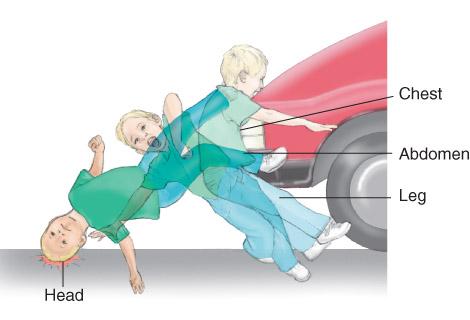 Children hit by cars often sustain chest, abdominal, thigh, and extremity injuries.