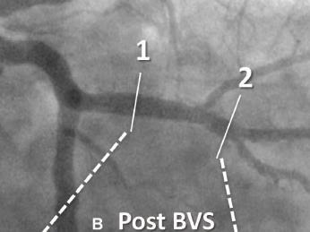 implantation; Fig. 1 mages Adapted Ormiston et. al. B, artery after deployment of a 3.