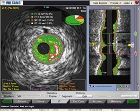 OCT offers better image quality, but IVUS still has niche