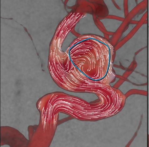 Various publications have shown that the flow pattern inside aneurysms is considered one of the parameters that can be used to predict rupture and clotting after device deployment.