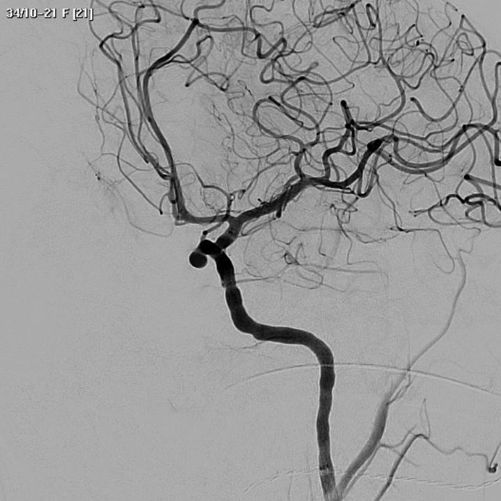 old. Saccular aneurysm in internal carotid artery.