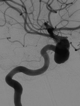 Saccular aneurysm in internal carotid artery.