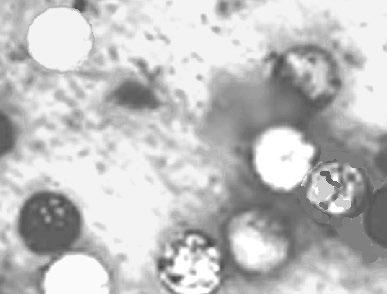 Cyclospora cayetanensis oocysts (modified acid-fast variable, 8-10 µm) SPECIMEN 5: Permanent Stained Smear: Digital Image, Stool, Maximum Magnification is 1000X (Trichrome) Use Micrometer embedded in
