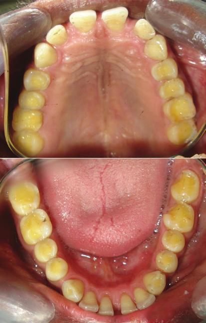 To produce standard effective cusp angles, the condylar and the incisal guidance were set to Condition 1.