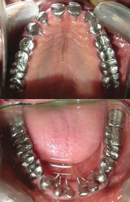 Now, to transfer the vertical dimension and centric relation, temporaries were removed from both maxillary and mandibular left posterior region while the temporaries of right and anterior maxillary