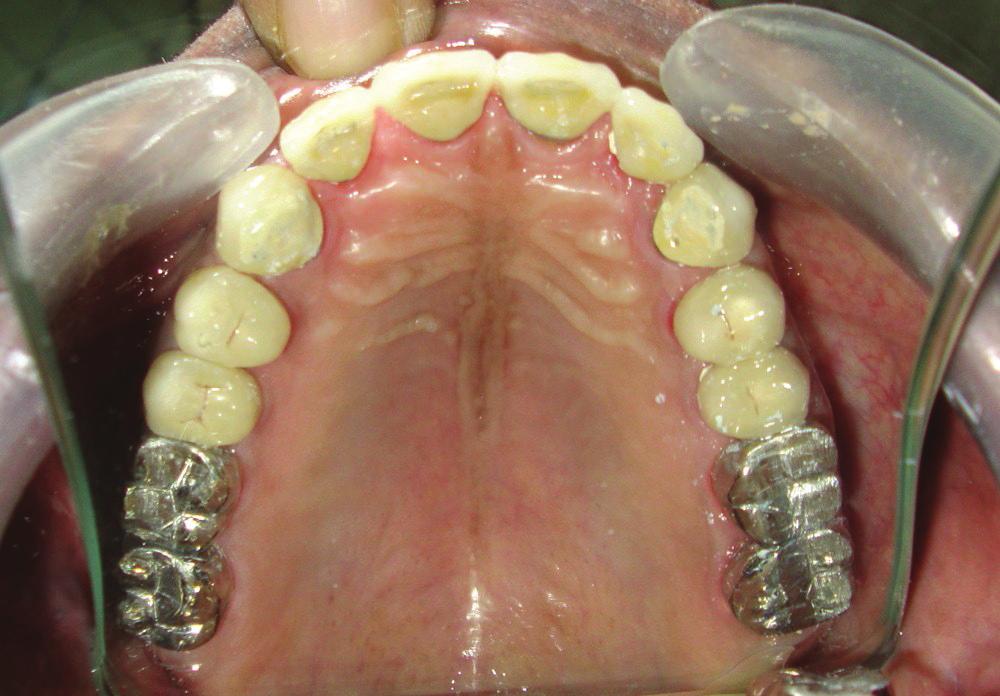 Likewise, the temporaries were removed from right maxillary and mandibular region while the temporaries were present in left an anterior region of both arches, interocclusal record was injected
