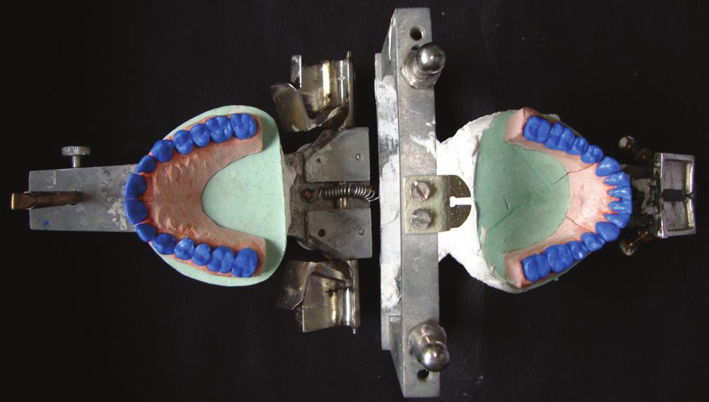 The three segmental interocclusal records thus obtained were used to mount the mandibular cast. 9.