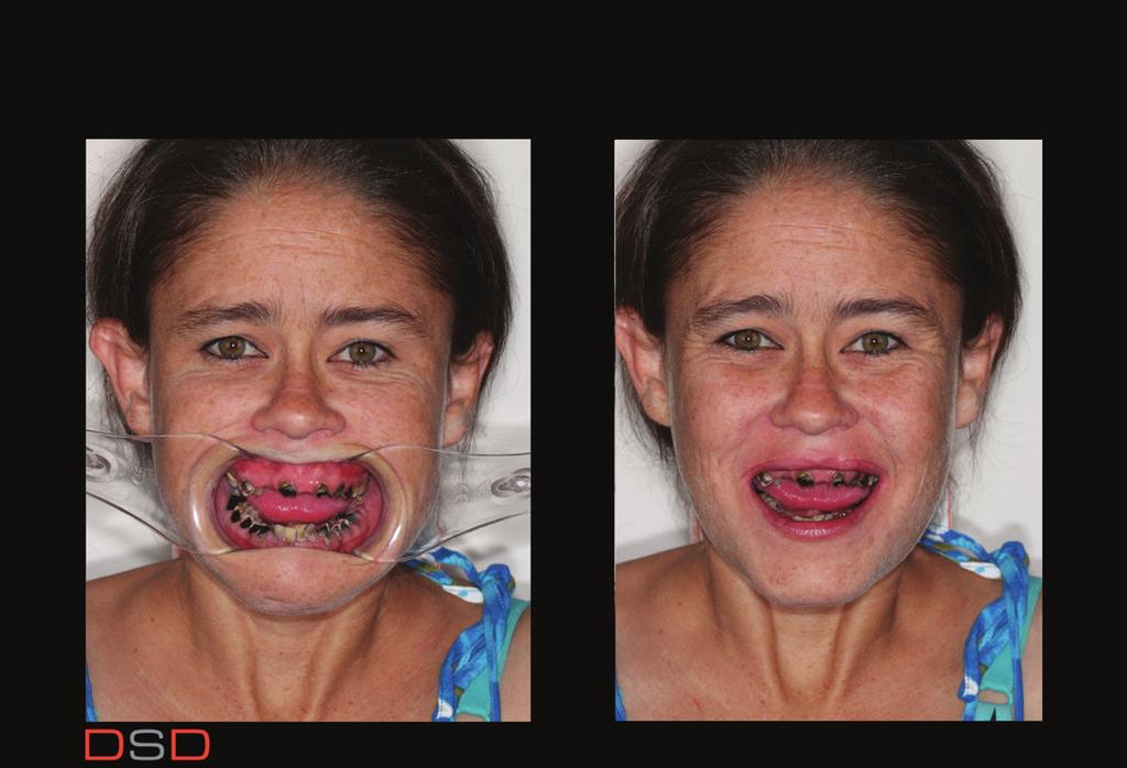 Figure 2. Retracted views of patient s dentition and smile. Figure 3.