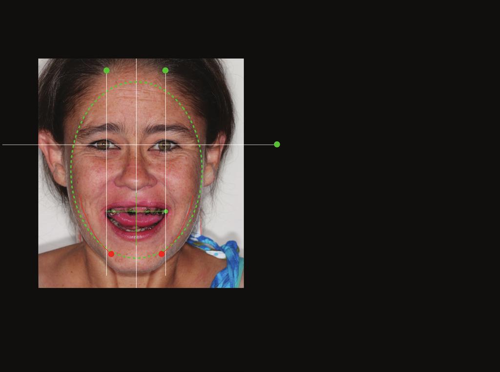 Figure 6. DSD smile curve overlay showing ideal teeth positioning and proportions with considerations to patients age gender and current dentition. Figure 5.