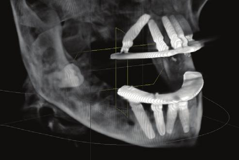 Note 48 was kept due to low chance of complications by leaving the tooth encased in bone and proximity to nerve. Figure 15.