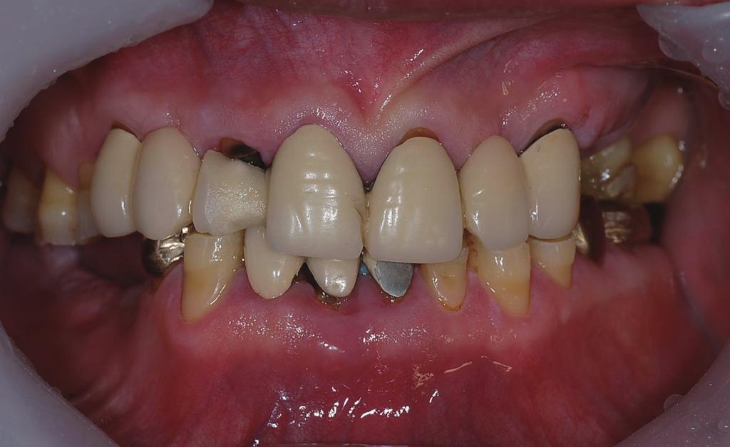 Park C Case Report A 63-year-old Korean man visited Department of Prosthodontics at Chonnam National University, Gwangju, Korea, with chief complaints of overall attrition of teeth and discomfortness
