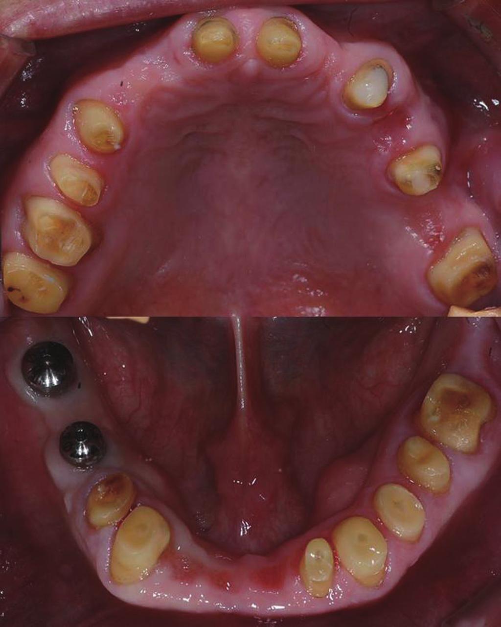 Application of ARCUS digma I, II systems for full mouth reconstruction: a case report provide adequate posterior disclusion.
